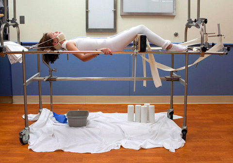 scoliosis brace gips escoliose garota suffers poetic puberty mostrou recuperar luta coluna severa assustadora cnn leidenschaft anmerkungen novafisio