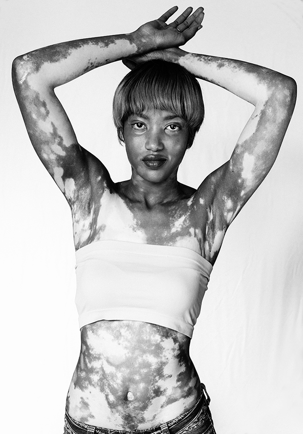 Behold the Beauty of Vitiligo Feature Shoot