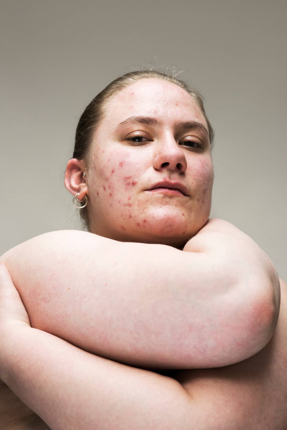From Vitiligo to Birthmarks: The Beauty of Human Skin